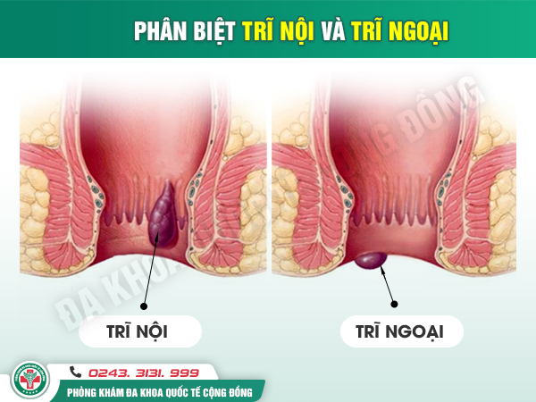 Trĩ nội khác trĩ ngoại như thế nào? Bác sĩ chỉ ra cách phân biệt chính xác