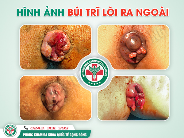 Búi trĩ lòi ra ngoài: Cách xử lý khoa học để ngăn ngừa biến chứng
