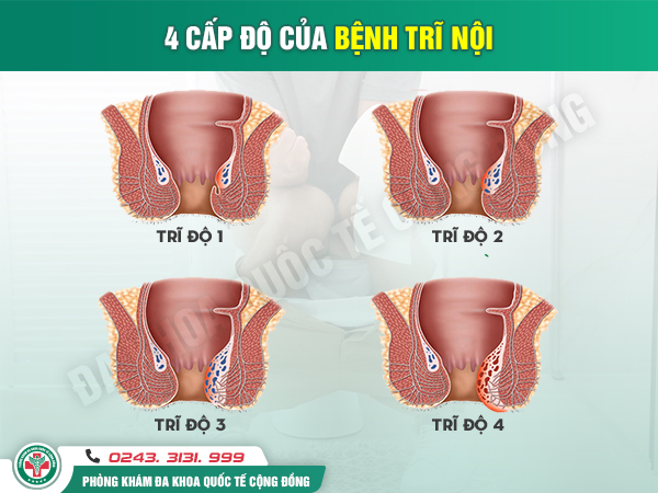 Các cấp độ trĩ nội người bệnh cần lưu ý