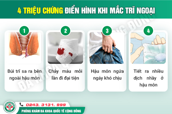 Trĩ ngoại có mấy cấp độ? Cách chữa bệnh như thế nào?