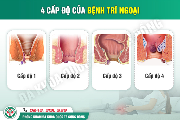 Bác sĩ chuyên khoa chia sẻ về cách làm co búi trĩ ngoại hiệu quả hiện nay
