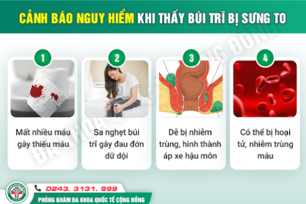 cách làm co búi trĩ