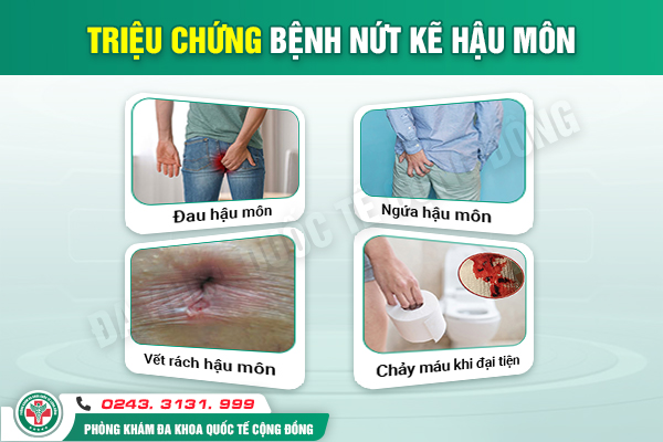 Nứt kẽ hậu môn phải làm sao? – Cùng chuyên gia giải quyết