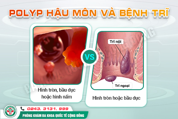 Phân biệt Polyp hậu môn và bệnh trĩ