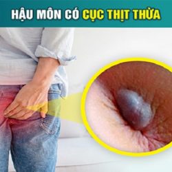 https://phongkhambenhtri.vn/wp-content/uploads/2024/10/cuc-thit-thua-hau-mon-250x250.jpg