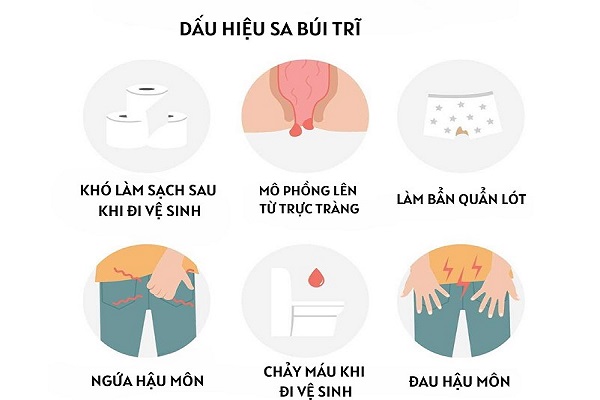 đấu hiệu búi trĩ sưng đau