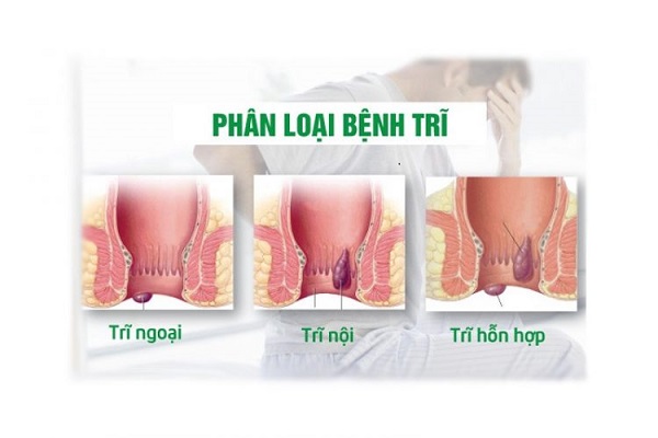 Tổng quan về bệnh trĩ hỗn hợp và những điều cần biết
