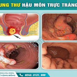 https://phongkhambenhtri.vn/wp-content/uploads/2024/10/ung-thu-hau-mon-250x250.jpg