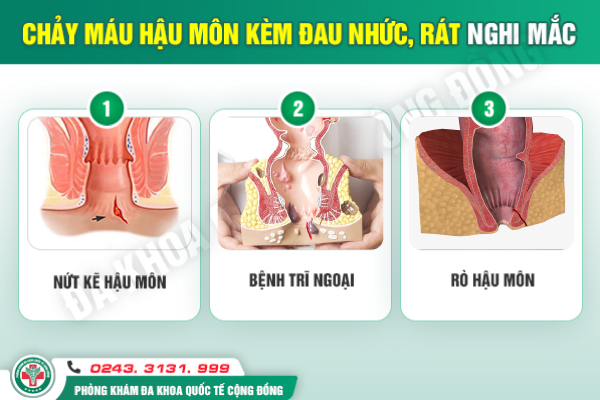 Chảy máu hậu môn là bệnh gì? Cảnh báo từ chuyên gia