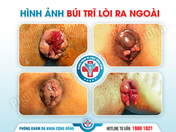 Nổi Cục Ở Hậu Môn: Đừng Nghĩ Là Chuyện Nhỏ, Có Thể Là Dấu Hiệu Bệnh Nguy Hiểm!