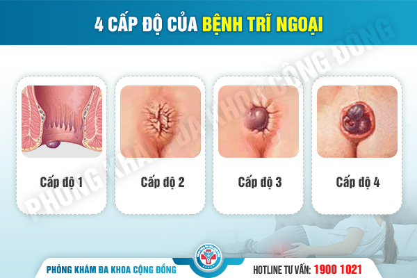 Bác sĩ chuyên khoa chia sẻ về cách làm co búi trĩ ngoại hiệu quả hiện nay
