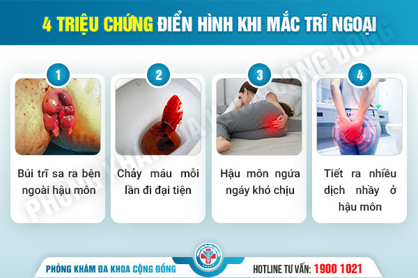 Trĩ ngoại có mấy cấp độ? Cách chữa bệnh như thế nào?