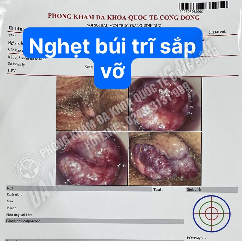 Bác sĩ chuyên khoa giải đáp: Chi phí cắt trĩ hết bao nhiêu tiền?
