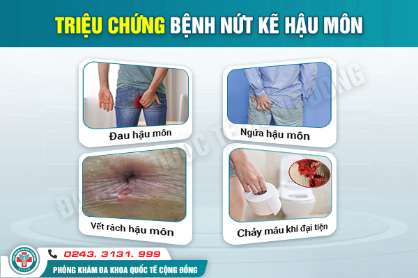 Tìm hiểu về nứt kẽ hậu môn và phương pháp điều trị hiệu quả