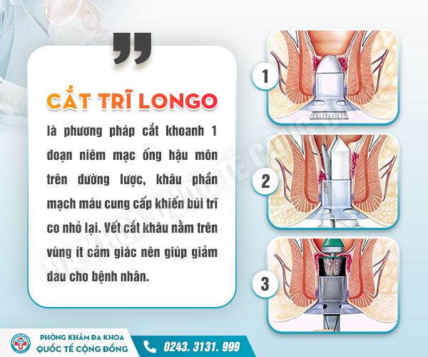 Phương pháp cắt trĩ Longo có dễ tái phát không?